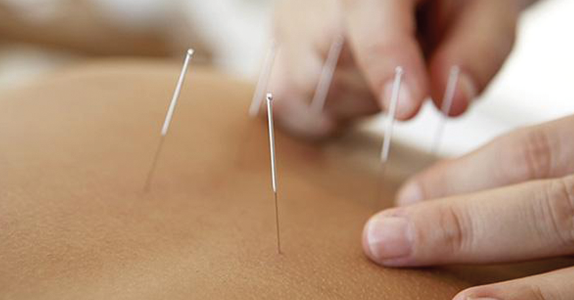 Acupuncture for sports